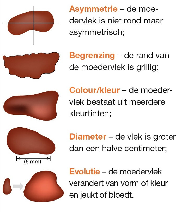 Wees alert op huidkanker