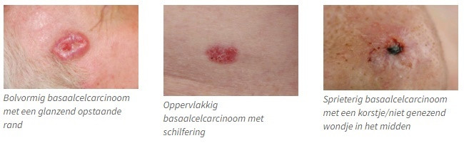 huidkanker